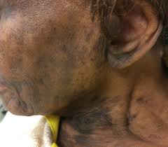 Image result for Diffuse Hyperpigmentation