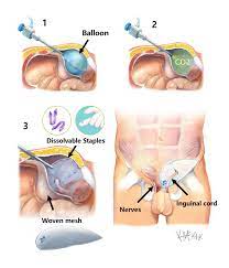 Groin Hernia Repair | Colorectal Surgeons Sydney
