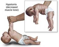 Prader Willi Syndrome Causes Symptoms Treatment Schoolworkhelper