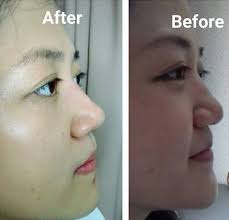 Radiesse Asian Nose Bridge Photos Rhinoplasty Cost Pics Reviews Q A