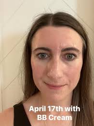 Acne before and after pictures