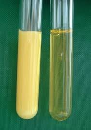 Image result for Hypertriglyceridemia