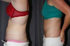 Pin On Bariatric Notes