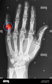 Image result for Interphalangeal Dislocation