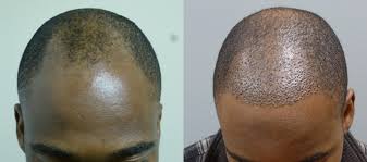 First, the surgical team uses an anesthetic to numb the patient's scalp so the procedure is comfortable. Hair Transplants Before After Gallery Hair Restoration Savannah Hair Restoration Savannah