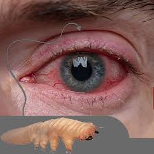 Image result for demodex rosacea