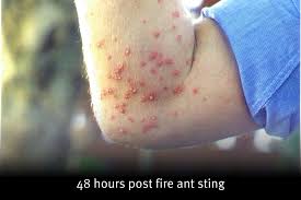 Image result for Fire Ant Sting
