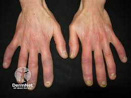 Image result for Connective Tissue Disorder
