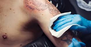 Tattoo Entfernung Ohne Laser Abschleifen Dermabrasion
