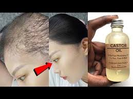 It's been known to aid in wound healing and has been used to treat skin conditions like dermatitis and fungal infections. Apply Castor Oil This Way N Turn Thin Hair To Thick Hair In 30 Days Double Hair Growth L Hairstyles For Thin Hair Thin Hair Care Castor Oil For Hair Growth