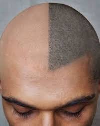 The terminology male pattern baldness, also referred to as androgenetic alopecia, is used to describe natural hair loss in men that cannot be. New Hair Restoration Technique Scalp Pigmentation Aka Tattoo Me An Edge Up Scalp Tattoo Hair Tattoos Hair Loss Solutions