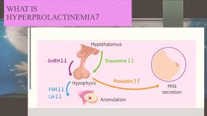 Image result for Hyperprolactinemia