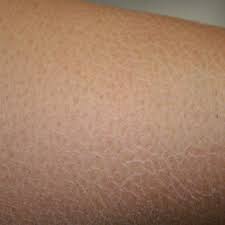 Xerosis (eczema craquelé, asteatotic eczema). Xerosis For Android Apk Download