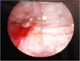 Abbreviations have a long tradition in medicine and used correctly can assist in the rapid communication of information about a patient. Cystoscopic Removal Of A Migrated Intrauterine Device To The Bladder A Case Report Contraception And Reproductive Medicine Full Text
