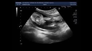Club foot was diagnosed by ultrasonography in 91 feet (52 fetuses) at a mean gestational age of @article{baron2005prenatalud, title={prenatal ultrasound diagnosis of club foot: Ultrasound Video Showing Club Foot Fetal Anomaly Scan Youtube