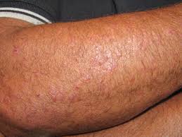 Image result for Polymorphous Light Eruption