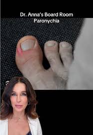 Image result for Paronychia feet
