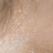 Image result for Cradle Cap