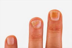 From home remedies to prescription treatments, these cures will return your feet to this treatment is effective for green nails which may have what's called 'atypical organisms,' says dr. What Your Nails Can Tell You About Your Health