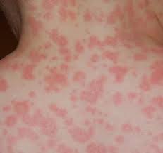 În practica clinică, petele roșii care apar pe corp sunt numite un tip de erupție care modifică culoarea suprafețelor pielii (în timp ce textura pielii și alți fotodermită, sau alergie la soare, este o afecțiune cauzată de radiațiile ultraviolete. Alergiile Ce Sunt Si Cum Le Tratam Dr Cristina Hanganu