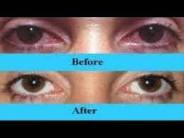 How To Naturally Whiten The Whites Of You Eyes Get A Sparkling White Eyes Youtube Whiten Eyes Red Veins In Eyes White Eyes