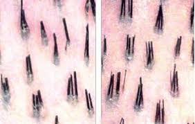 They grow from follicles found in the skin. Multiple Two Hairs One Follicle On Scalp Armpit Pubic Area Get Rid Hair Mag