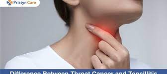 Oropharyngeal cancer arises in the throat, soft palate, tonsils or base of the tongue. Difference Between Throat Cancer And Tonsillitis Pristyn Care