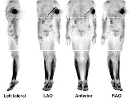 Learn about its symptoms and risk factors, plus how this cancer develops. Pet Imaging Of Osteosarcoma Journal Of Nuclear Medicine