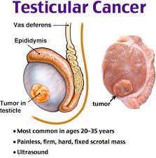This is also called testicular cancer bone metastasis. Testical Cancer Cancer Association Of Namibia Wo30