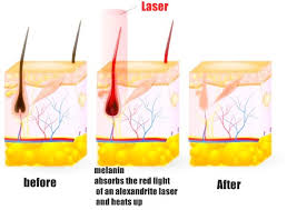 It can also reduce hair density by 64%. How Does Laser Hair Removal Work Laser Hair Removal Melisa Laser Clinic