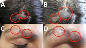Lupus can cause the hair on your scalp to gradually thin out, although a few people lose clumps of hair. Cureus Systemic Lupus Erythematosus Presenting As Alopecia Areata