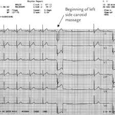Pdf Recurrent Syncope Due To Carotid Sinus Hypersensitivity And Sick Sinus Syndrome