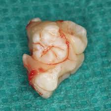 Odontome Is A Benign Tumour Composed Of Normal Dental Tissue That Has Grown In An Irregular Way Dental Assistant Study Dental Dentistry