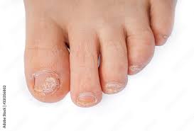 Image result for Onycholysis feet
