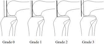 The anterior drawer test has to be performed exactly. Posterior Drawer Test This Is Done By Determining The Distance Of The Download Scientific Diagram