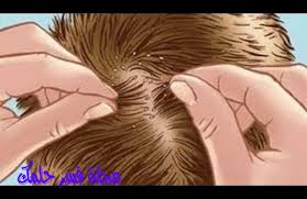 تفسير حلم رؤية القمل في المنام للرجل والمرأة المتزوجة والعزباء احلامي دوت نت