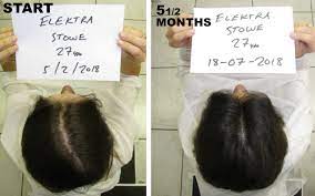 Hair salon in kingston upon hull. Dr Alexander Hairloss