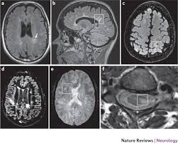 Oral radiology, principles and interpretation. The Current Role Of Mri In Differentiating Multiple Sclerosis From Its Imaging Mimics Nature Reviews Neurology