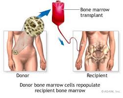 A unique aspect of our mpn research program is the establishment of the largest central mpn tissue bank and the corresponding clinical database worldwide. Bone Marrow Stem Cell Transplant