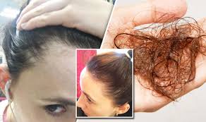Corticosteroid injections women with hair loss due to alopecia areata may consider treatment with corticosteroids injected at multiple sites in the affected area. Hair Loss Cure Breakthrough Treatment Found By Woman Who Lost Hair Express Co Uk