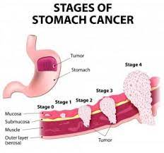 The symptoms, which can include an upset stomach and general stomach discomfort, are for example, an upset stomach can be mistaken for indigestion or a stomach virus. Stomach Cancer Gastric Adenocarcinoma Symptoms Causes And Treatment Science Online
