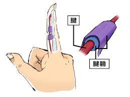 腱鞘炎の治し方 原因からチェック方法 予防法まで徹底解説 bauhutte 腱鞘炎 ばね指 解説
