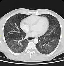 Scleroderma Pulmonary Manifestations Radiology Reference Article Radiopaedia Org