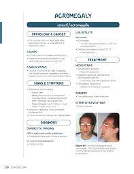 Image result for Acromegaly