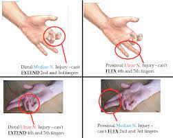 Dnyyr Png 842 672 Pixels Ulnar Nerve Median Nerve Hand Therapy
