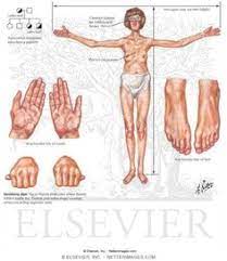 Marfan Syndrome Copy Copy