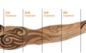 Indianapolis's top rated tattoo removal center we are a tattoo removal center that delivers results. Tattoo Removal Or Lightening By Skin Renew Day Spa Laser Center In Indianapolis In Alignable