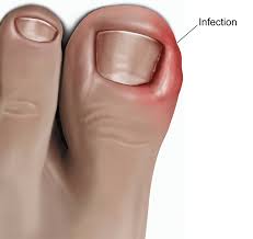 Image result for Toenail Removal