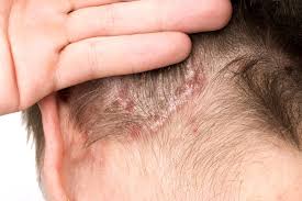 Di video kali ini saya membahas atau mengasih info , masih tentang ketombe tebal sampai berkerak di kulit kepala, 4 di jamin ketombe hilang total ketombe tebal dikulit kepala segera obati, kalau. Psoriasis Kulit Kepala Penyebab Gejala Obat Dll