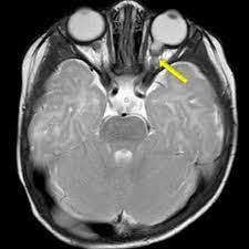 Morning Glory Disc Anomaly Eurorad